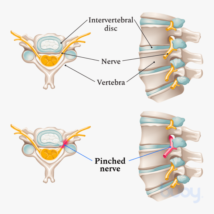 The Anatomy Of A Pinched Nerve